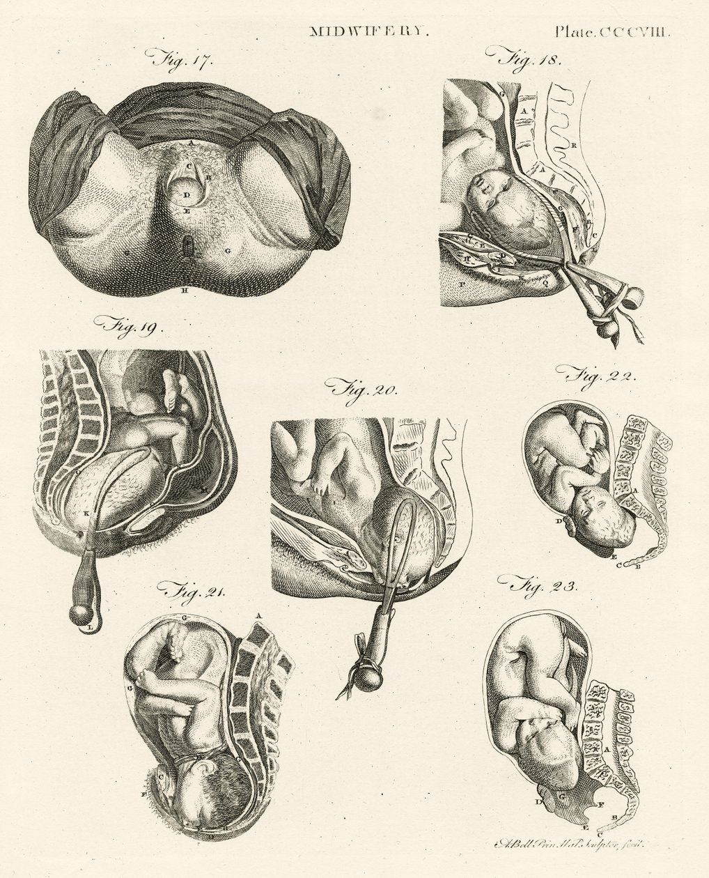 Obstetrícia, ilustração de &39;Encyclopedia Britannica&39;, publicada em Edimburgo, 1798 (gravura em chapa de cobre) de Alexander Bell