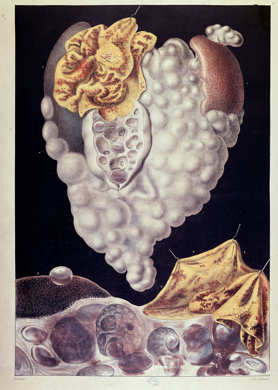 Cancro - de Cruveilhier de Jean Cruveilhier